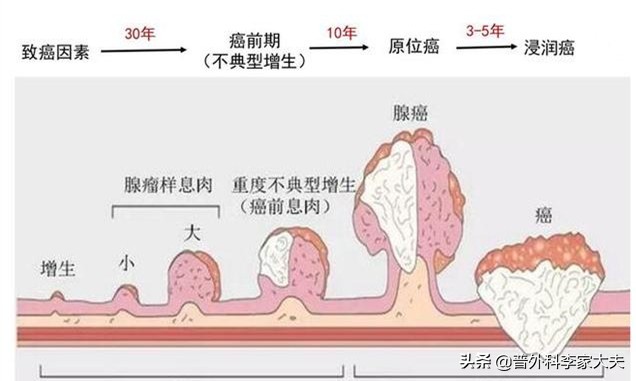 结直肠中，为什么乙状结肠、直肠部分肠癌发病率高？