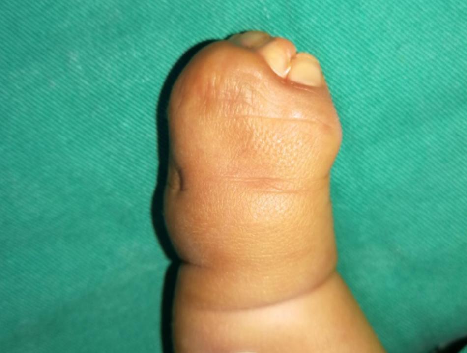 并指畸形免植皮案例,并指畸形