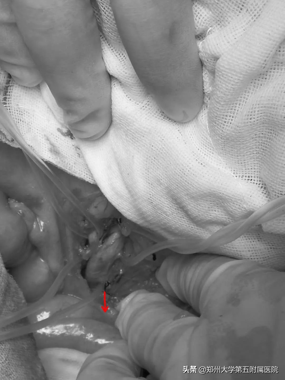 房颤患者的噩梦之不一样的急性腹痛——肠系膜上动脉栓塞