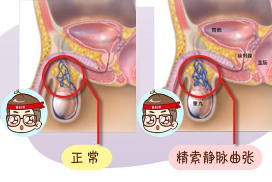 男性精索静脉曲张做什么运动恢复,男性精索静脉曲张是什么原因引起