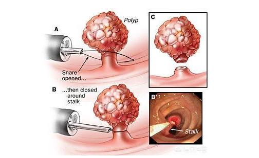 普通肠镜要是有息肉直接切除痛吗,肠镜有痛可以做切除息肉吗