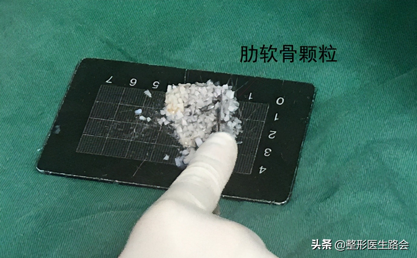 想做隆鼻的女孩,肋软骨填充鼻基底会拉长人中吗