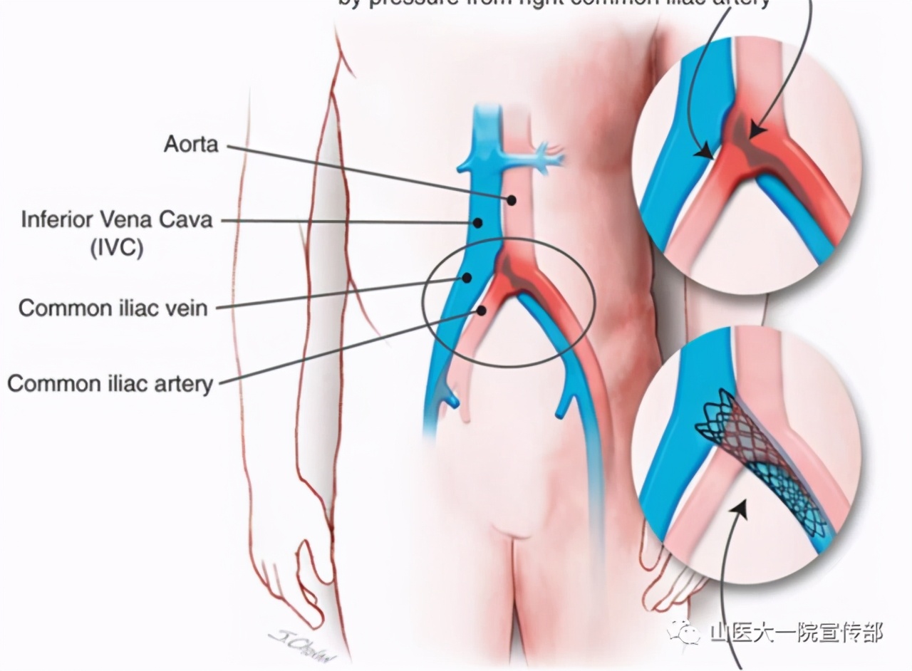 来山医大一院看病治好了十多年的*毛老**病
