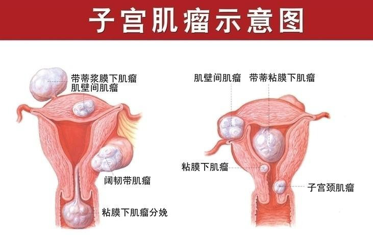 绝经期子宫肌瘤5.6厘米需要手术吗,我43岁有子宫肌瘤