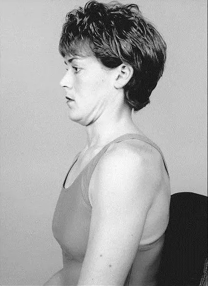 麦肯基疗法治颈椎全套视频,麦肯基治疗神经根型颈椎病