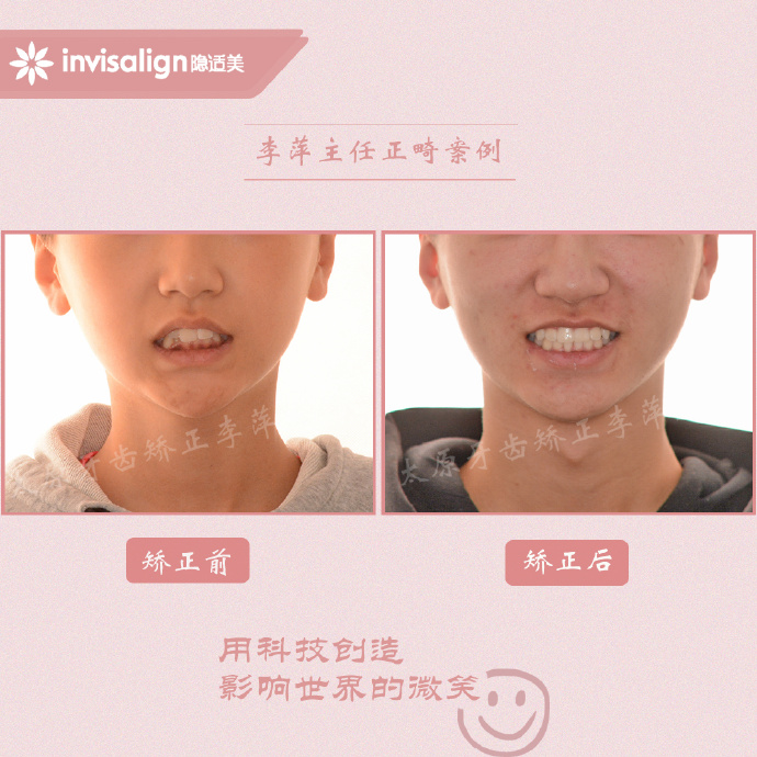山西太原牙齿矫正医院十大排名,太原市牙齿矫正成功案