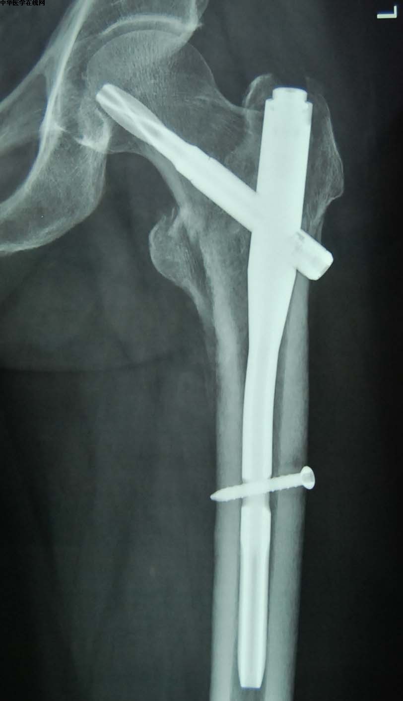 老年人骨质疏松严重造成腰骨折,髋部骨折包括哪些骨折