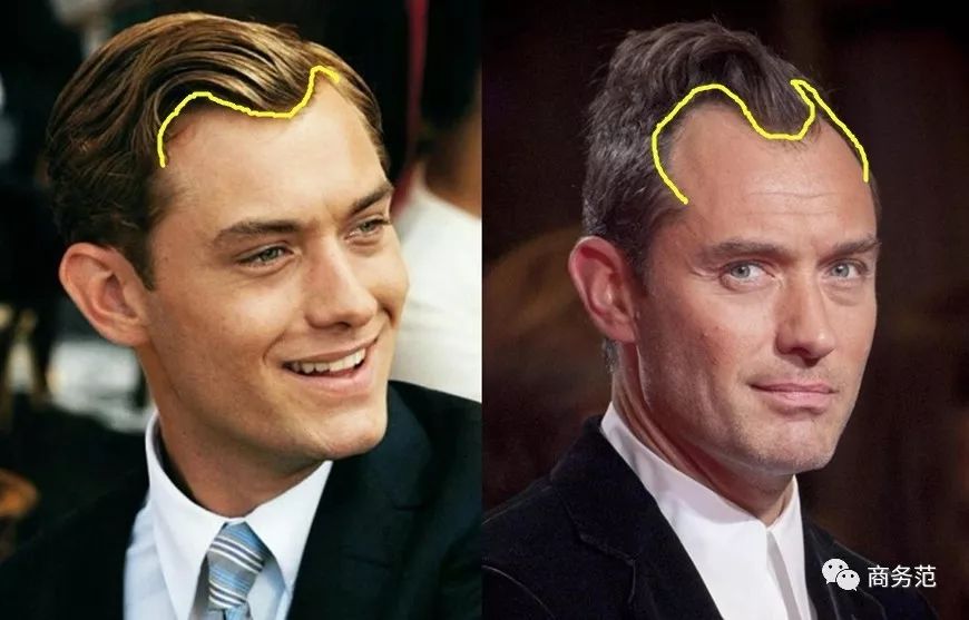 威廉王子秃顶了哈里为啥没秃顶,威廉王子为什么喜欢秃顶