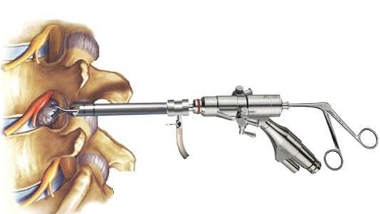 腰椎间盘突出针灸有副作用吗,腰椎间盘突出针灸越来越严重