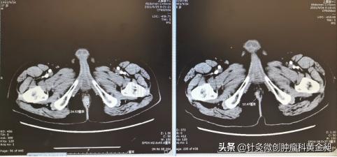 直肠术后的难言之隐,直肠癌脱出肛外的症状