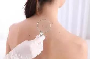 到底该不该做激光祛斑,激光点疣祛痣注意事项