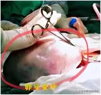 孕期卵巢囊肿会变癌吗,怀孕发现卵巢囊肿会变癌吗