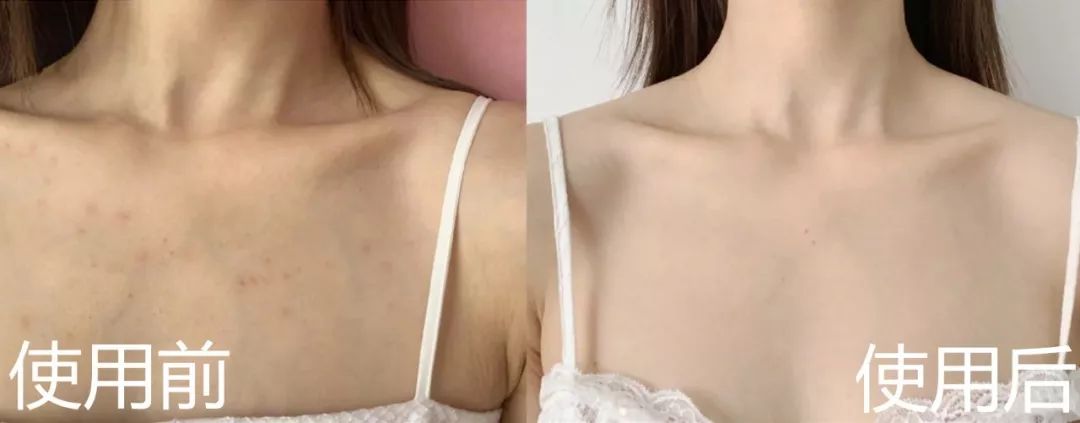 别再乱用清洁面膜了,如何正确洗脸既能白还能长痘