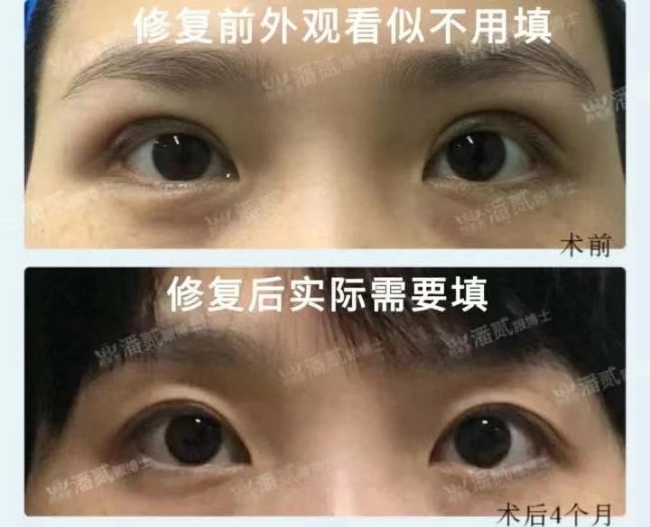 割双眼皮眼皮压下来会恢复吗,割双眼皮以后会松弛更快吗