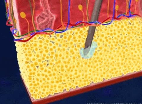 抽脂成为当下女性减肥潮流,抽脂减肥:想怎么瘦,就能怎么瘦?