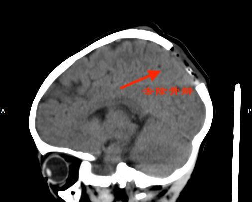 小孩头上长肿块是良性还是恶性,女童头上有个小疙瘩像疣