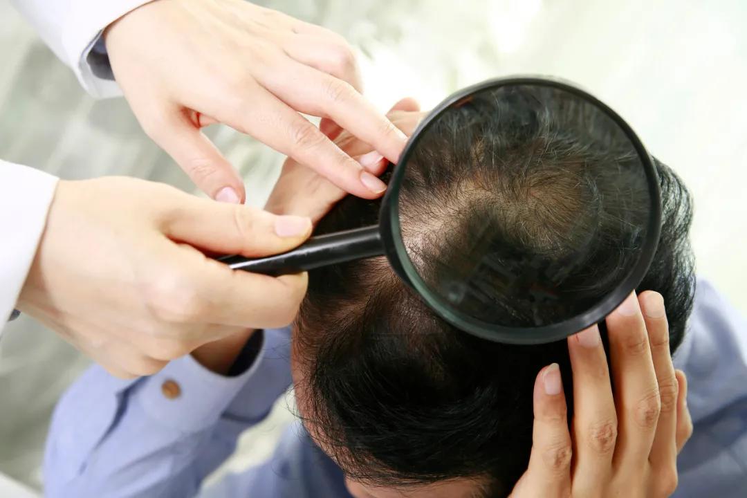 斑秃掉发后一直不长是什么原因,斑秃长出来的头发又掉了