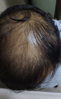 脱发有救了浓密秀发,脱发养发黑发