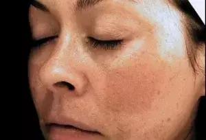 只需3步淡化斑点,简单4招快速淡化色斑