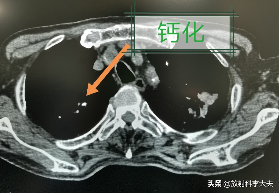 几年前得过肺结核现在胸透有阴影,结核治疗一年了还有胸痛
