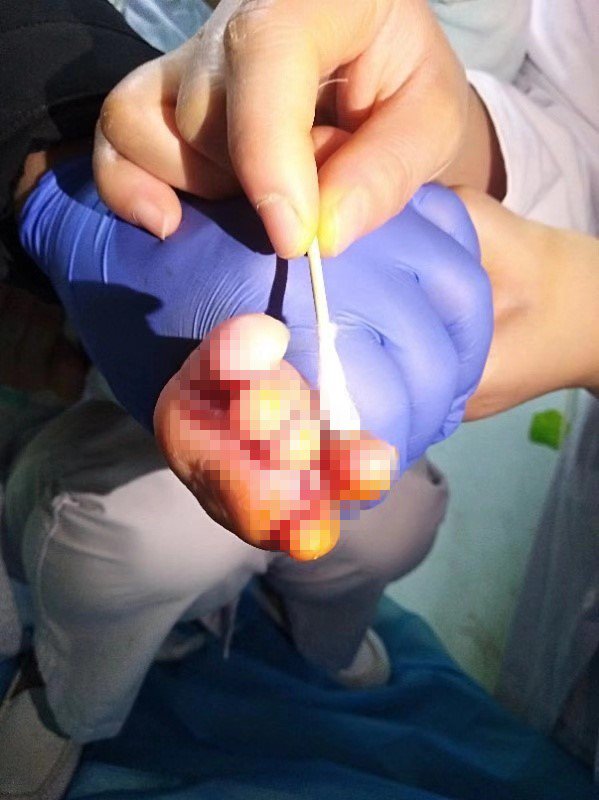 婴儿脚趾甲边上起脓泡挑破可以吗,婴儿脚趾长肉刺红肿