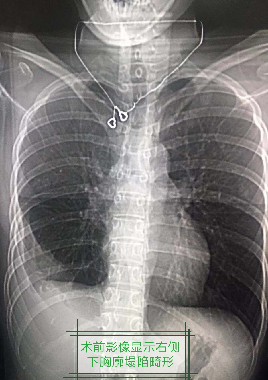 慢性脓胸手术费用报销,慢性脓胸哪里治得好