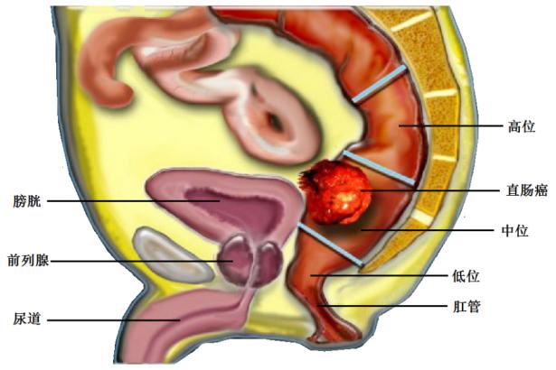 直肠癌保肛术后排大便困难怎么办,直肠癌保肛手术大便失禁怎么办