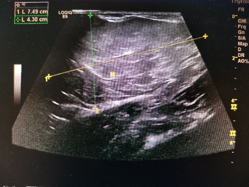 脂肪瘤的案例,脂肪瘤的产生机理