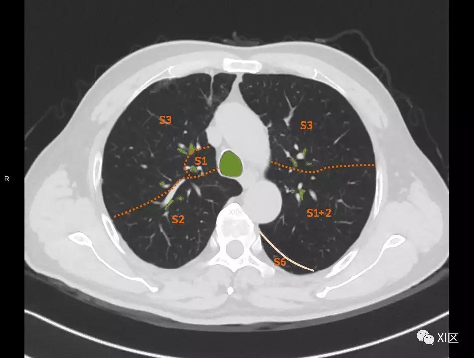 如此详细的肺部影像解剖，有点儿酷