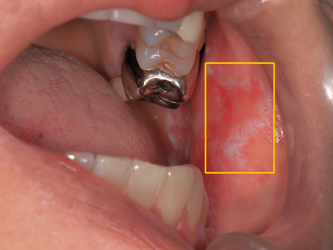 嘴巴内壁里有白色条纹是什么情况,嘴巴内壁长了白色长条是什么