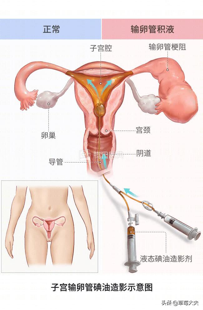 医生也成“催生婆”?不!是你输卵管出问题了......