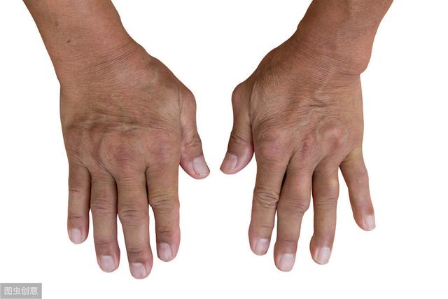 警惕高尿酸的案例,尿酸高痛风急性发作怎么处理