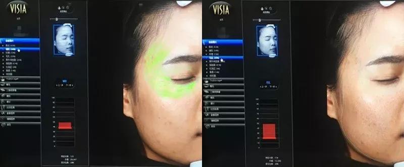 别再用针挑！用米澳拉，脂肪粒自己“掉”下来，效果胜过医美激光