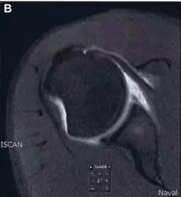 几种严重骨折医学名称,常见的骨折有哪些名称