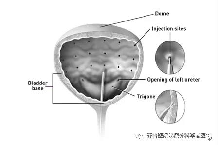 联合疗法治愈他的顽疾-神经源性膀胱
