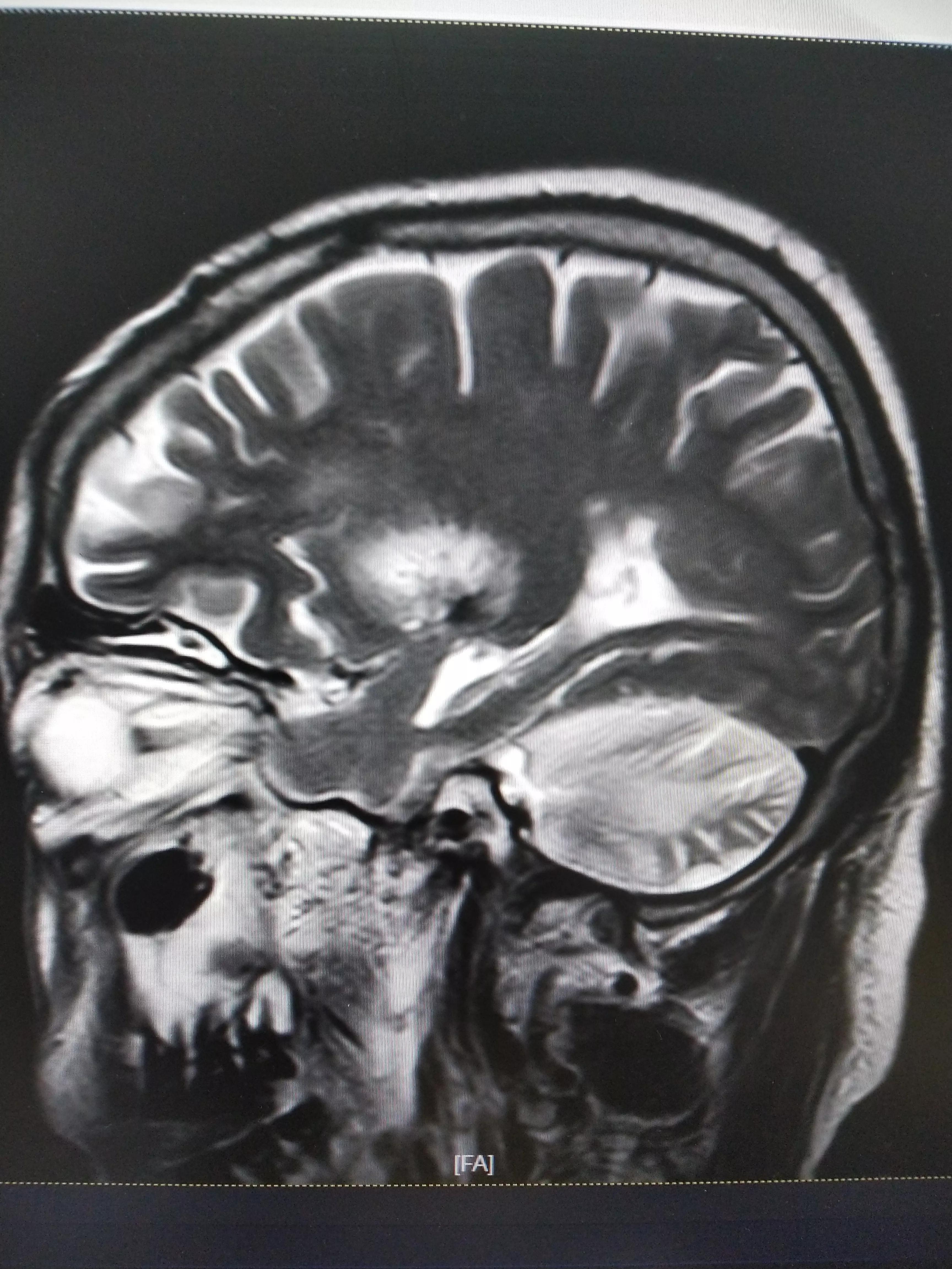 30岁中风,脑中风昏迷不醒的辨证与治疗
