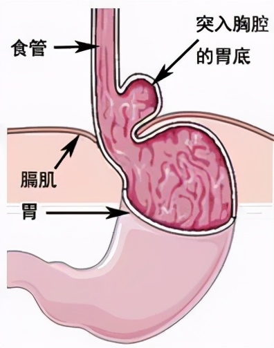 “烧心”是怎么回事？建议常“烧心”的朋友这样做