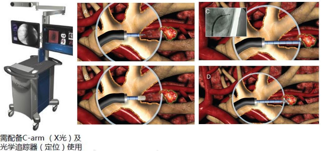 支气管镜高频电刀治疗中央型肺癌,支气管镜在早期肺癌诊断的意义