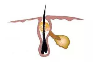 卸妆水可以去除鼻子上的黑头吗,鼻子上的黑头去除后怎么收缩毛孔