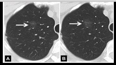 华西廖正银教授治肺结节,华西医院肺癌专家唐小军