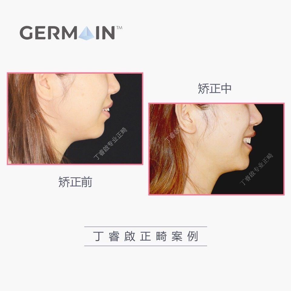 郑州牙齿矫正丁睿啟|下巴后缩病例合集