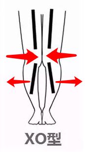 小腿不直该怎么办,小腿不直肌肉外翻怎么办