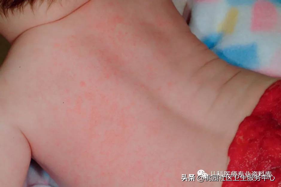 儿童湿疹和痱子要分清楚,成人痱子和湿疹如何分别