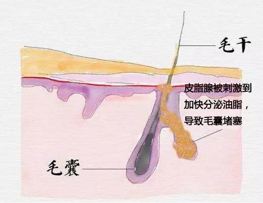 说说都如何治好痘痘的,一痘毁所有5个祛痘小技巧