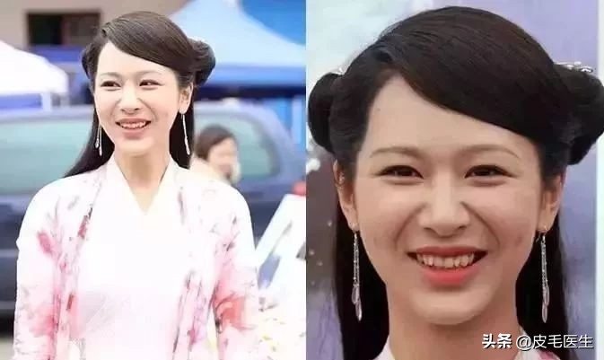 笑出法令纹!还能肆无忌惮地笑吗?正常笑!但改掉这5个习惯