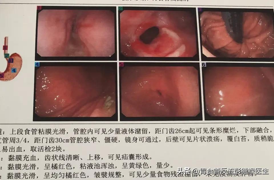 非萎缩性胃炎伴胆汁反流,胆汁反流性胃炎能喝茶吗