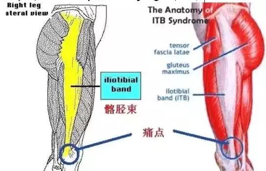 跑步膝盖髂胫束疼痛怎么治疗,跑者最怕的疾病
