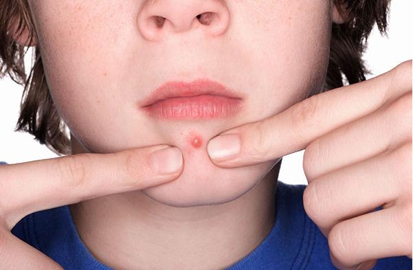 背上长痘千万别用青草药!谭中医为你提供一招妙方