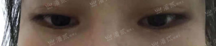 女孩眼部整形失败,内眼角整形失败