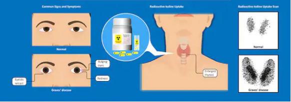 甲状腺功能亢进症的科普文章,甲状腺功能亢进症适宜的治疗方法